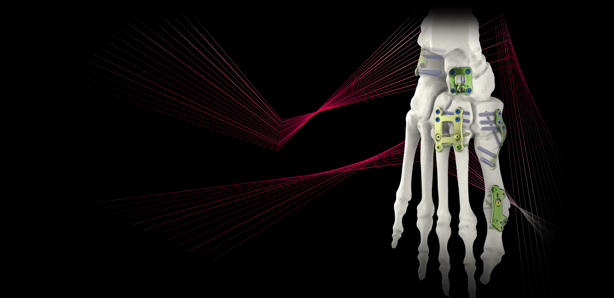 Footmotion Plating System foot surgery Newclip Technics