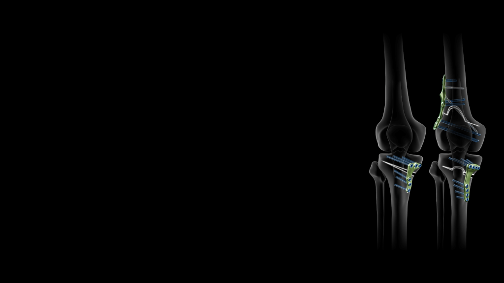 Lower Limb. - Newclip Technics