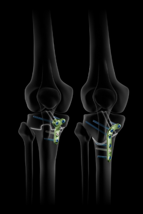 ActivMotion S. - Osteotomy plates - Newclip Technics