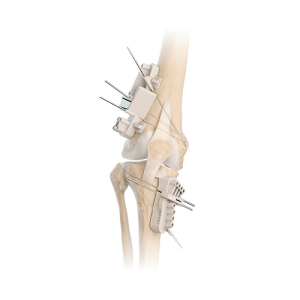 Activmotion S - Osteotomy plates - Newclip Technics