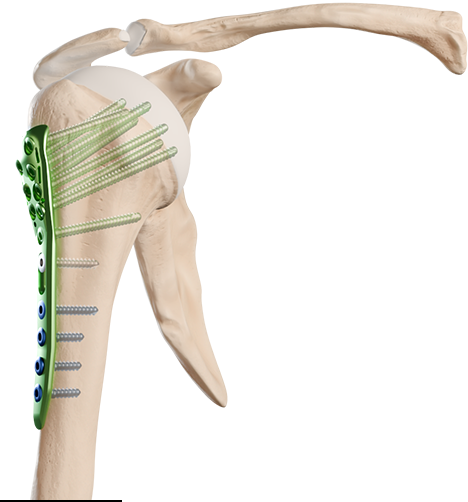 PROXIMAL HUMERUS