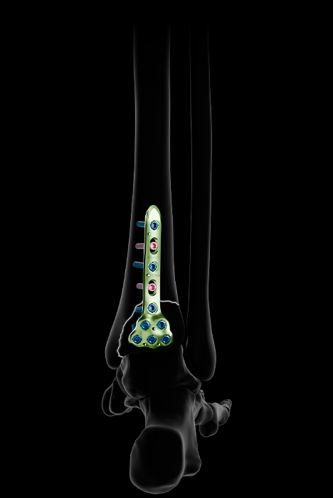 Xpert Ankle - Newclip Technics